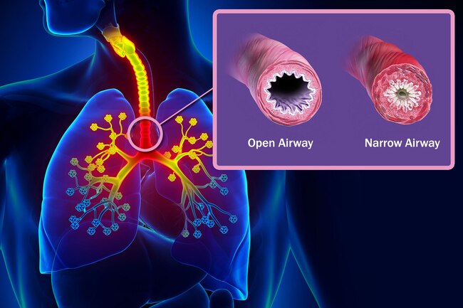 Asthma Case 