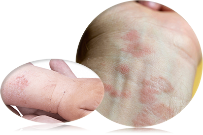 What is eczema? - Eczema cases