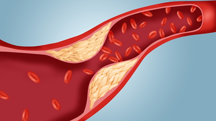 HOMEOPATHIC TREATMENT FOR HIGH BLOOD CHOLESTEROL!