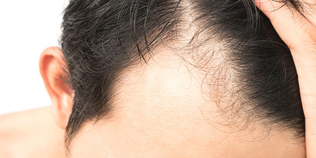 Alopecia Areata and Hair Fall - Hair loss treatment