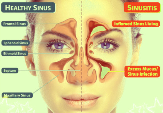 sinusitis conditions
