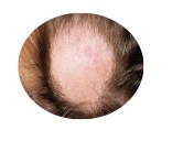 Alopecia 