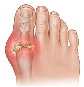 Gout Treatment