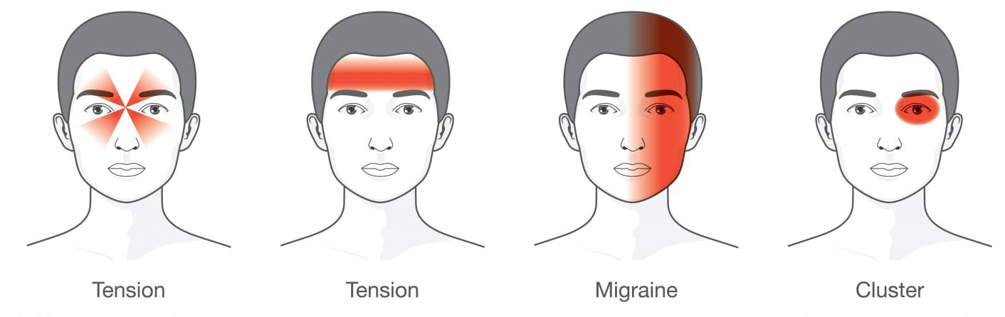 Headache Types