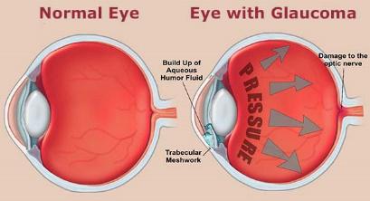 Glaucoma 